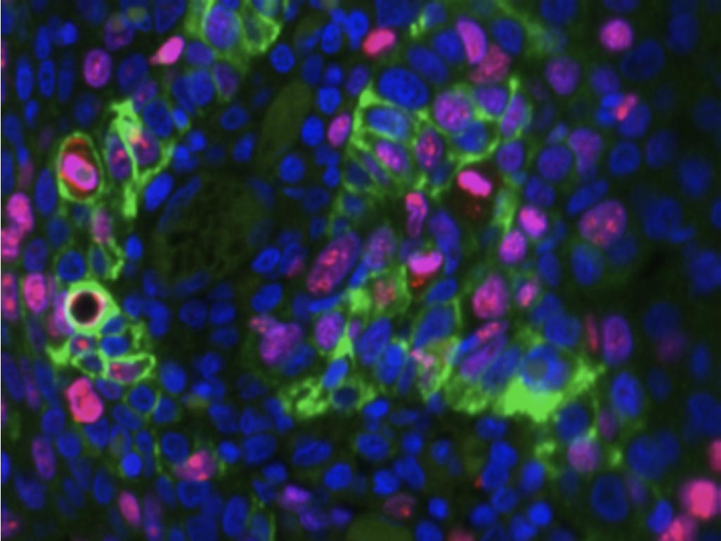 マウスに移植した胆管癌の免疫染色の画像