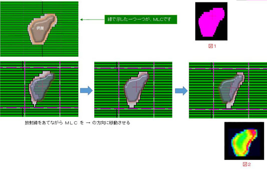 強度変調放射線治療の説明図