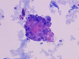 尿中に出てきた異形細胞の写真