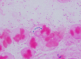 検体中の白血球に貪食されている細菌の写真