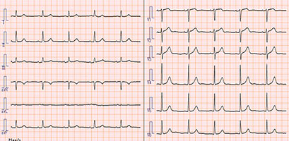 心電図の写真