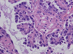 顕微鏡で見た癌の組織の写真