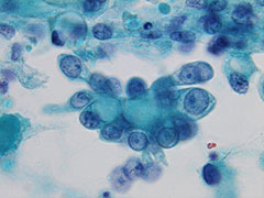 顕微鏡で見た癌細胞の写真