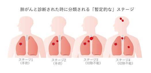 肺がんと診断された時に分類される「暫定的な」ステージ