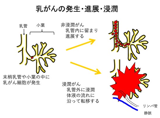 乳がんのは発生・進展・浸潤