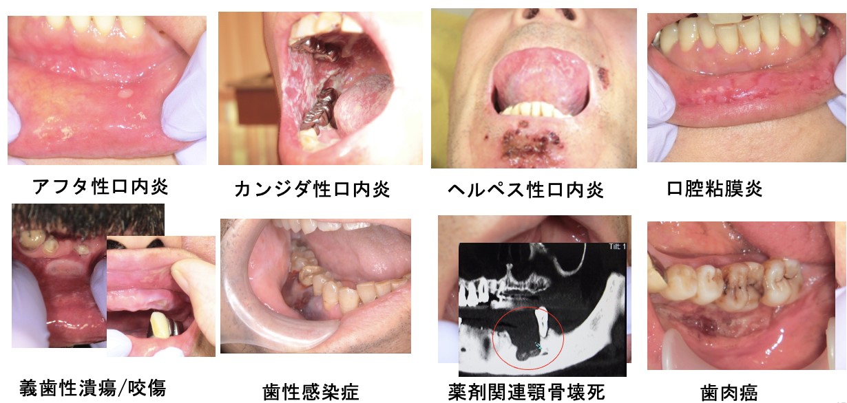 口腔内の副作用