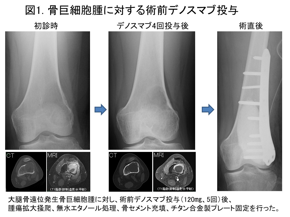 図1.骨巨細胞腫に対する術前デノスマブ投与