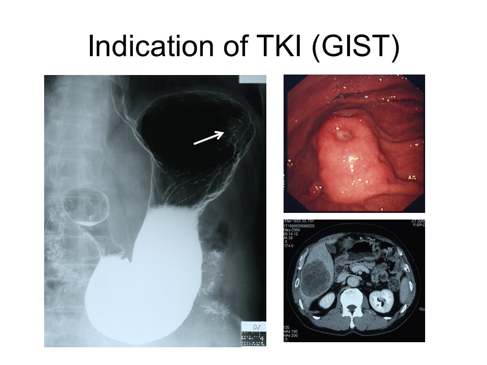 Indication of TKI（GIST）
